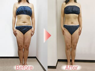 背中のタルミもスッキリ！！　（箕面市５１才Ｏ様）