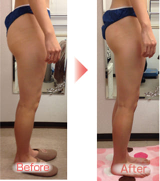 【小さいお尻に変わりました！（宝塚市　20代）】