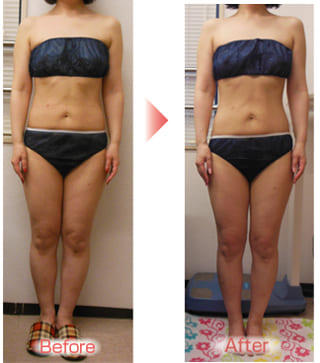 【むくみ足が解消しスッキリです。（池田市　５０代）】