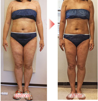 【娘の卒業式までに痩せました♬（池田市　４０代）】